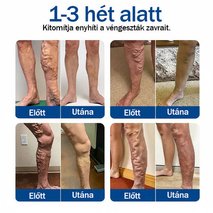 💚Medistart® Visszérápoló Mikrotűs Gondozó Tapasz ⚡ Azonnali Megkönnyebbülés, Hosszú Távú Eredmények