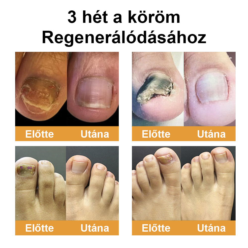 ☁️Természetes megoldás a körömgomba végleges eltávolítására ✨ Nincs szégyen, nincs vegyszer. Látható javulás*🔥
