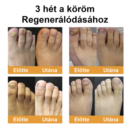 ☁️Természetes megoldás a körömgomba végleges eltávolítására ✨ Nincs szégyen, nincs vegyszer. Látható javulás*🔥
